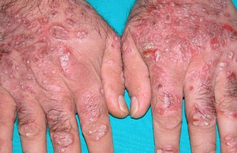 drip psoriasis on the hands