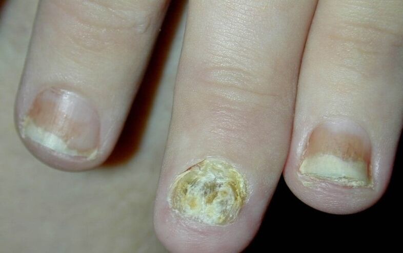 psoriasis of the nails of the hands