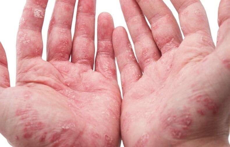 psoriasis on the palms
