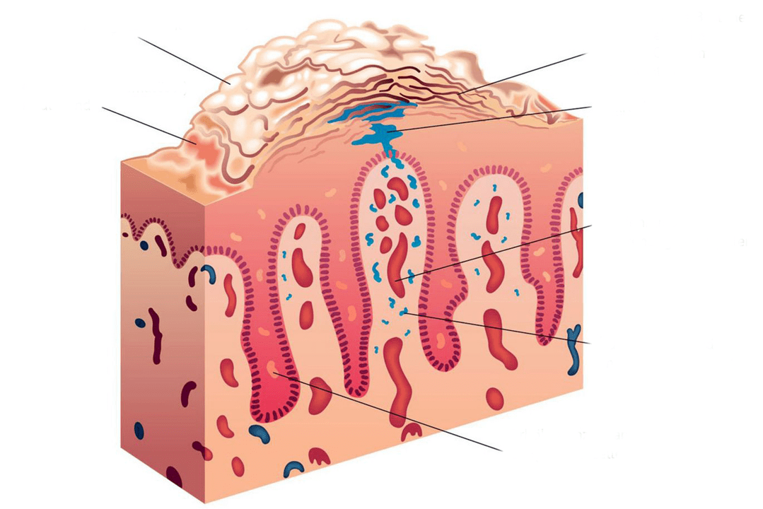 cross section of the skin in psoriasis