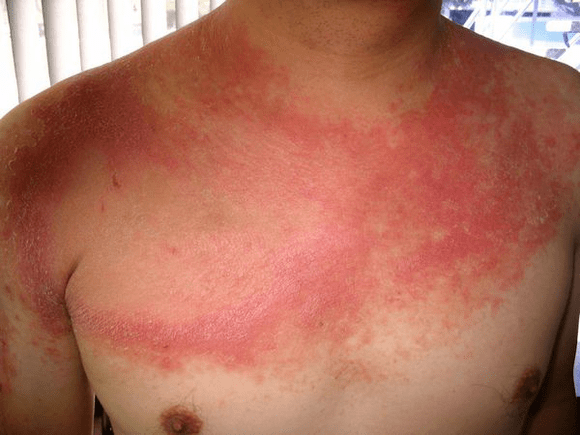 sore psoriasis on the body