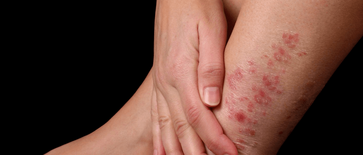 Plaques of psoriasis on the skin of the leg