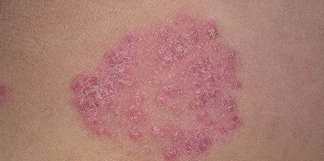 papules on the skin of the legs with psoriasis