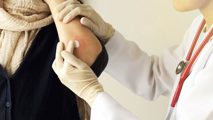 the doctor smears the elbow for psoriasis