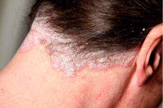 psoriasis free scalp