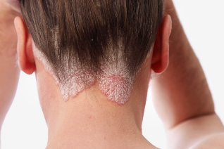 why psoriasis free scalp