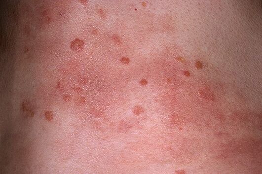 progressive stage of the course of psoriasis