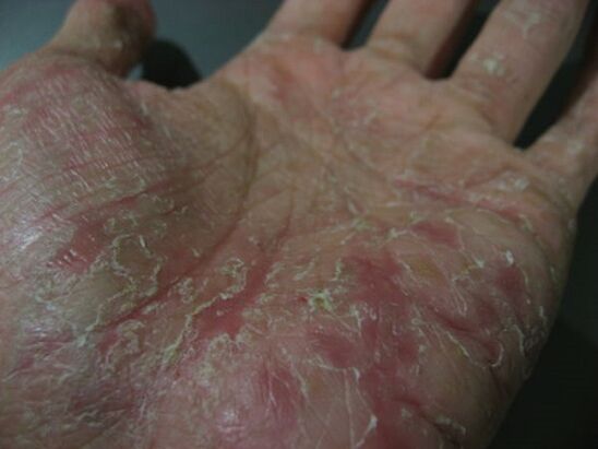psoriasis in the palm of your hand