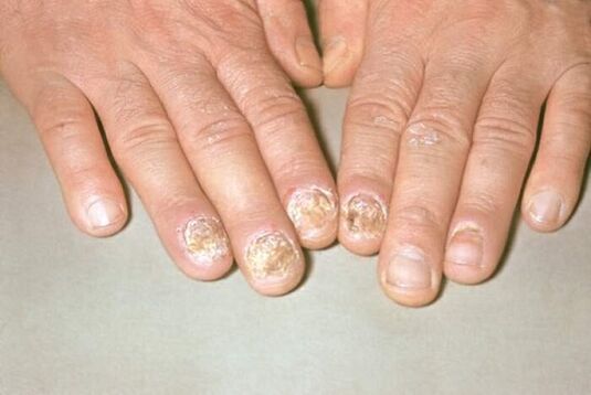 psoriasis nail photo 1