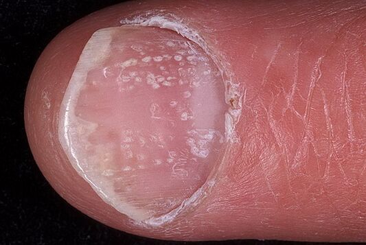 psoriasis nail photo 2