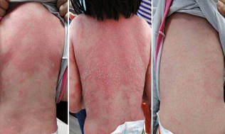 what looks like psoriasis in children