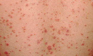 what looks like psoriasis of the initial phase