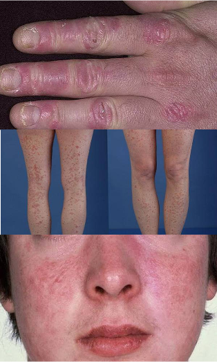 what looks like psoriasis on the hands feet and face
