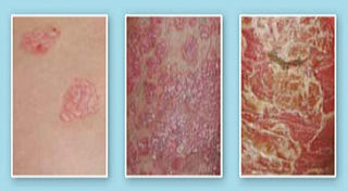 the phase of psoriasis