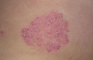 the disease of psoriasis
