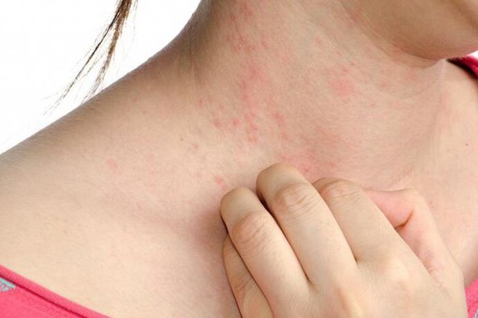 Exacerbation of psoriasis is manifested by skin rashes and severe itching