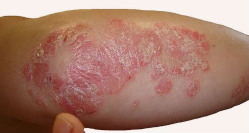 Scaly, bulky plaques on the elbow during exacerbation of psoriasis