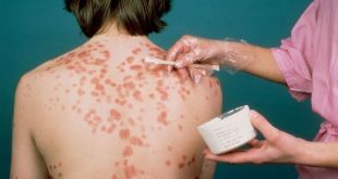the means of treatment of psoriasis