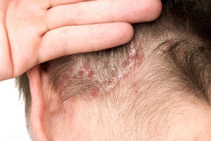 Exacerbation of psoriasis on the head