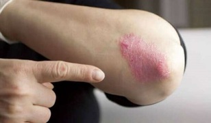steady stage of development of psoriasis