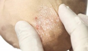 treatment of dying psoriasis