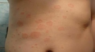 how to recognize the initial stage of psoriasis