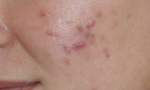 symptoms of the initial stage of psoriasis