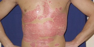 the instructions on the manner of treatment of psoriasis