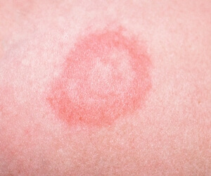 The initial stage of psoriasis