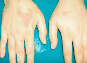 The location of the disease on the hands