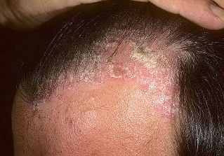 psoriasis on the head