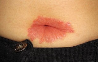 Other psoriasis