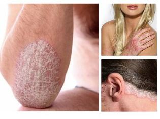 What is psoriasis and how to treat it