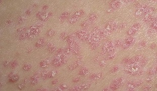 The initial stage of psoriasis