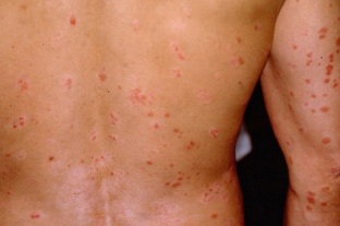 psoriasis of the initial phase