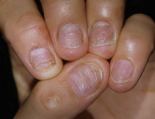 psoriasis of the nails